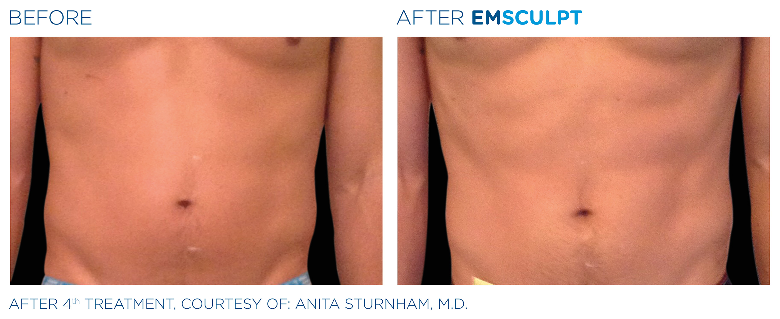 Body Sculpting Treatment: What To Do Before and After A Procedure